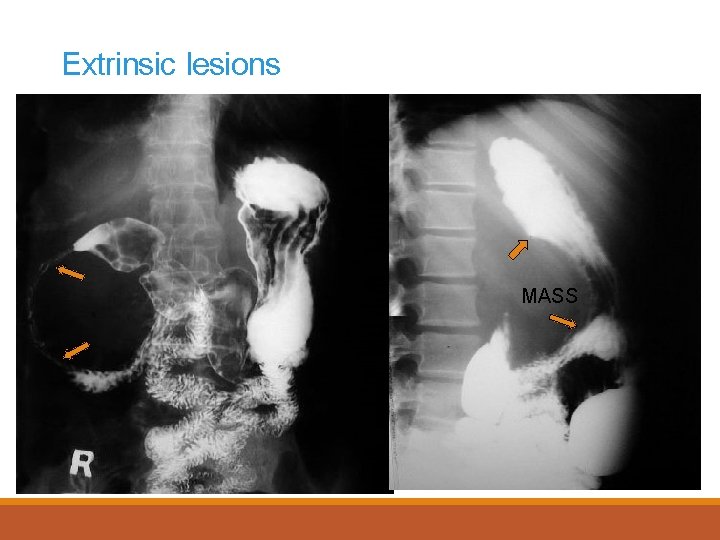 Extrinsic lesions MASS 