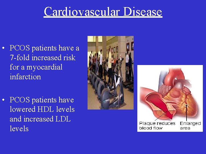 Cardiovascular Disease • PCOS patients have a 7 -fold increased risk for a myocardial