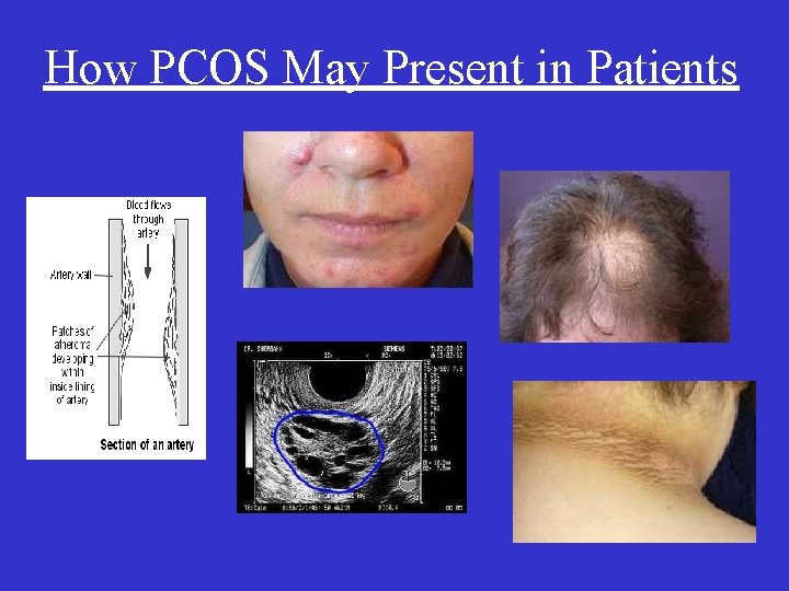 How PCOS May Present in Patients 