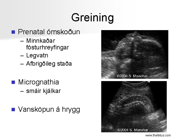 Greining n Prenatal ómskoðun – Minnkaðar fósturhreyfingar – Legvatn – Afbrigðileg staða n Micrognathia