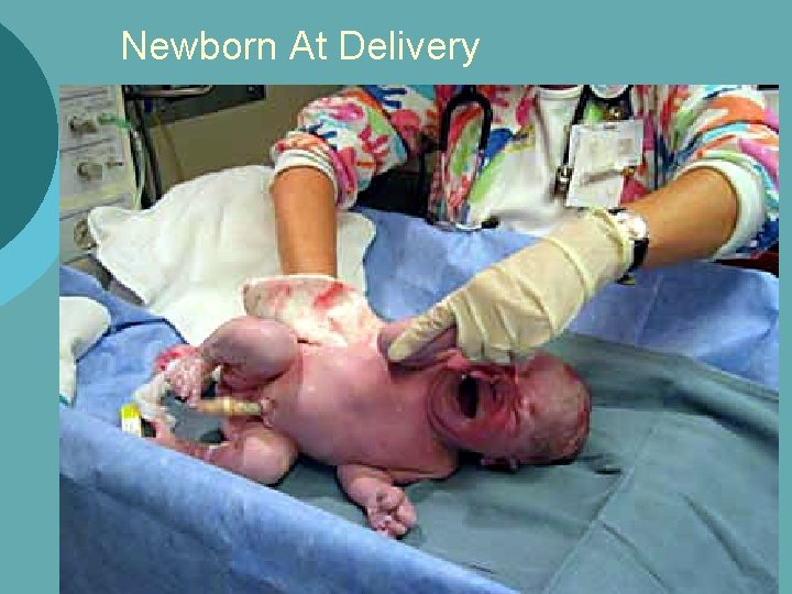 Newborn At Delivery 
