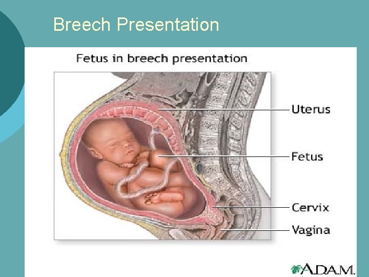 Breech Presentation 