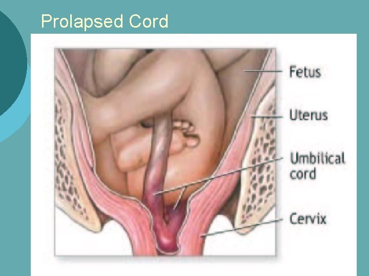 Prolapsed Cord 