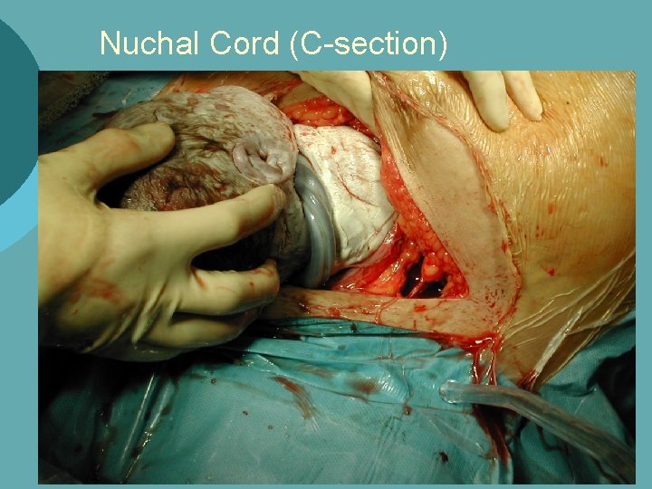 Nuchal Cord (C-section) 
