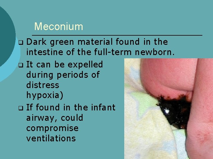 Meconium Dark green material found in the intestine of the full-term newborn. q It