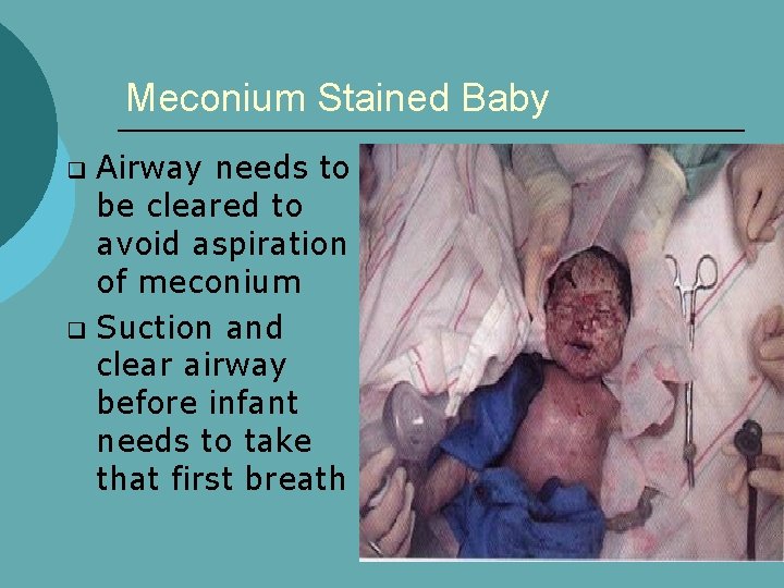 Meconium Stained Baby Airway needs to be cleared to avoid aspiration of meconium q
