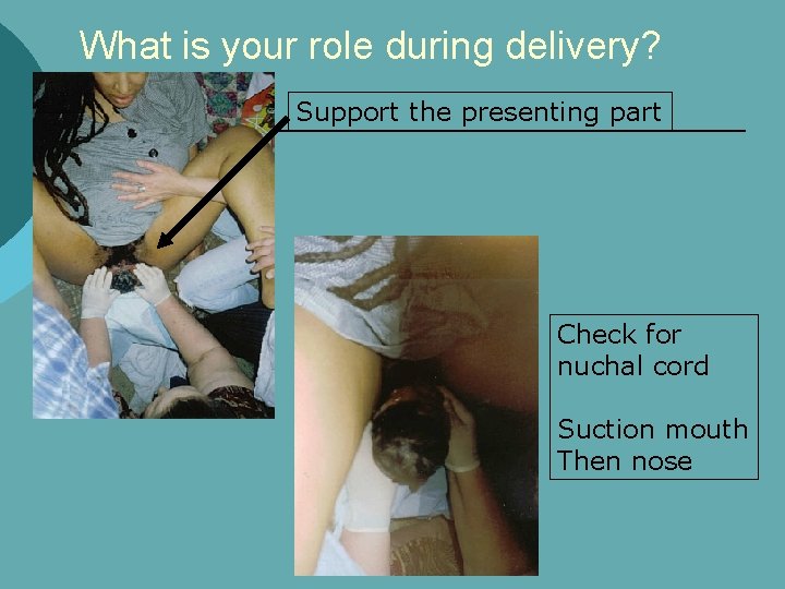 What is your role during delivery? Support the presenting part Check for nuchal cord