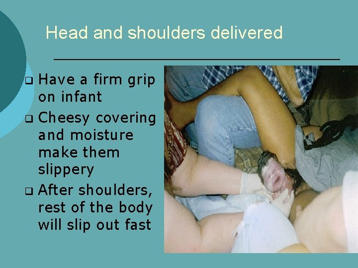 Head and shoulders delivered Have a firm grip on infant q Cheesy covering and