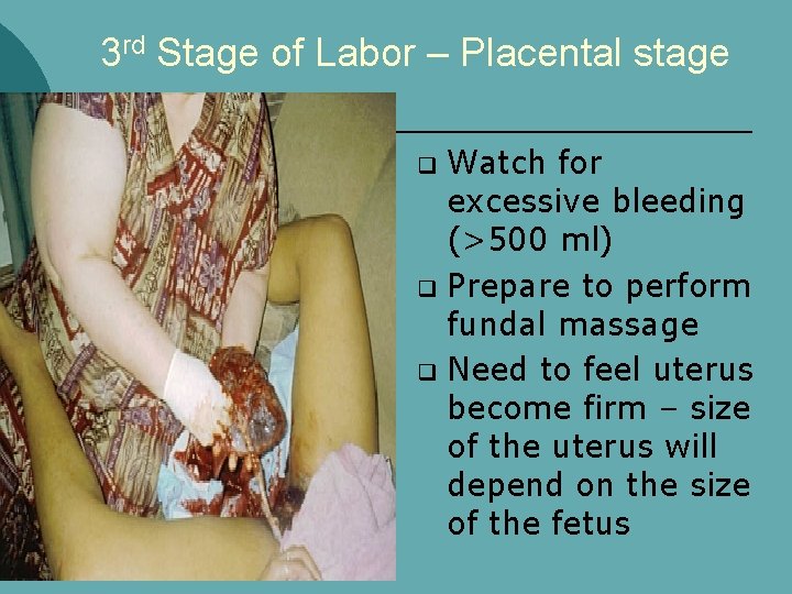 3 rd Stage of Labor – Placental stage Watch for excessive bleeding (>500 ml)