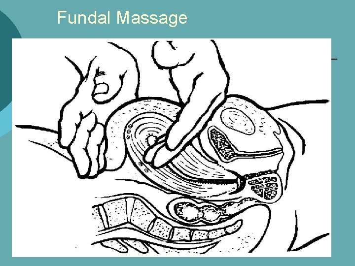 Fundal Massage 