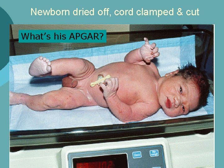 Newborn dried off, cord clamped & cut What’s his APGAR? 