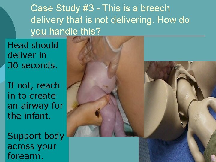 Case Study #3 - This is a breech delivery that is not delivering. How