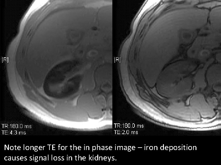 Note longer TE for the in phase image – iron deposition causes signal loss