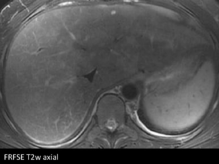 FRFSE T 2 w axial 