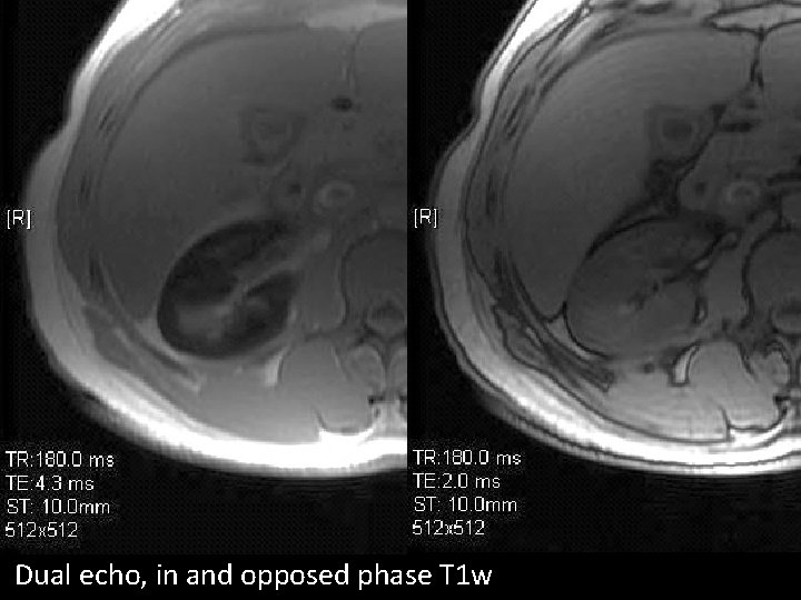 Dual echo, in and opposed phase T 1 w 
