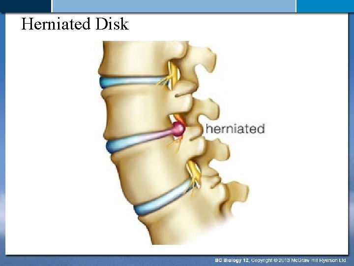 Herniated Disk 