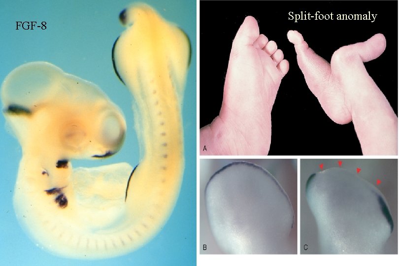 Split-foot anomaly FGF-8 