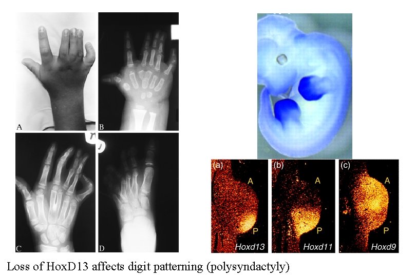 Loss of Hox. D 13 affects digit patterning (polysyndactyly) 
