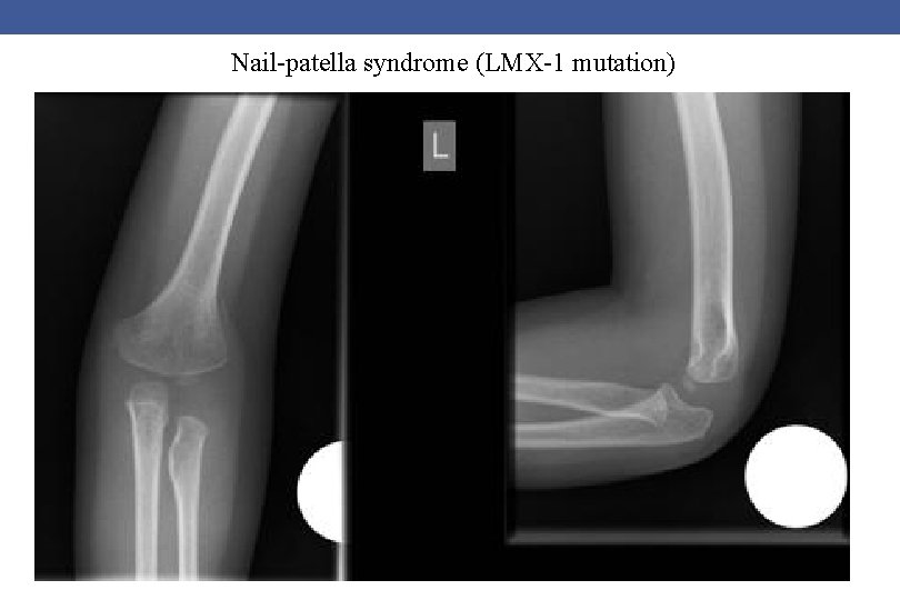 Nail-patella syndrome (LMX-1 mutation) 