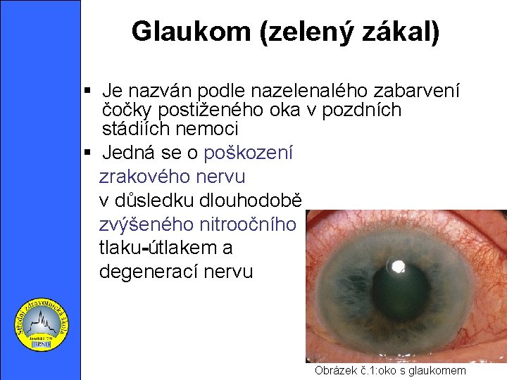  Glaukom (zelený zákal) Je nazván podle nazelenalého zabarvení čočky postiženého oka v pozdních