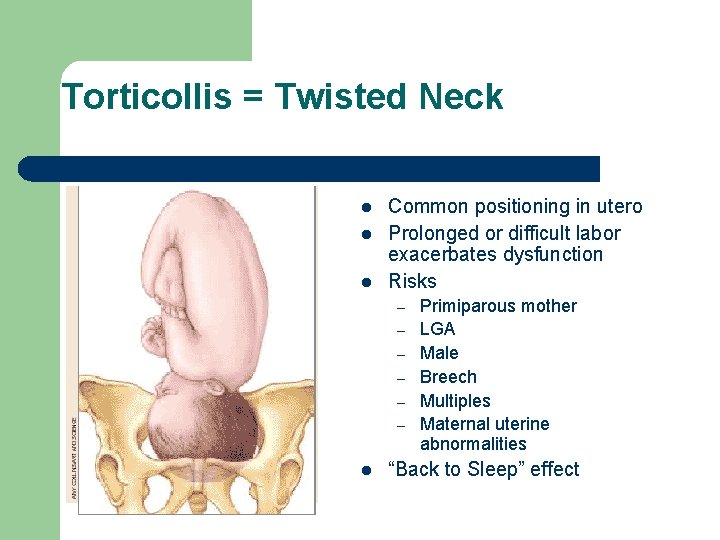 Torticollis = Twisted Neck l l l Common positioning in utero Prolonged or difficult