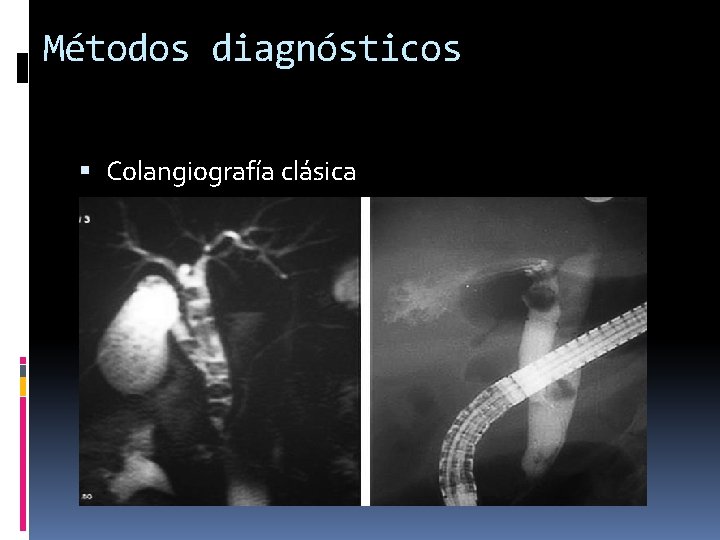 Métodos diagnósticos Colangiografía clásica 
