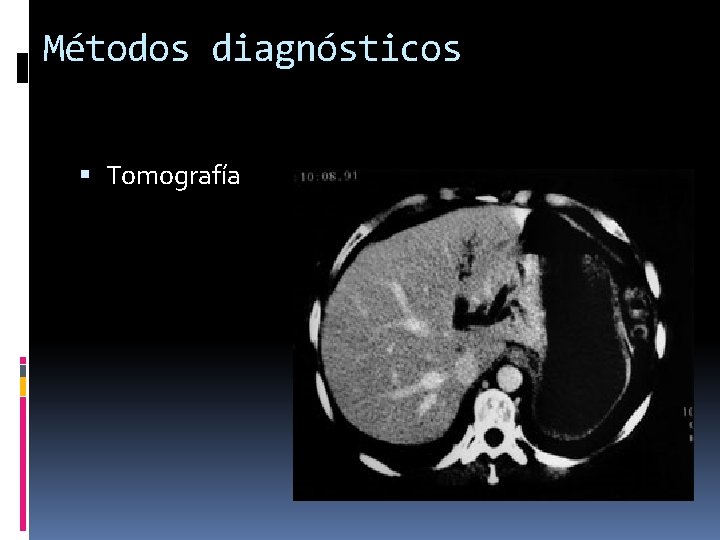 Métodos diagnósticos Tomografía 