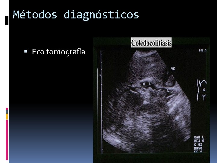 Métodos diagnósticos Eco tomografía 