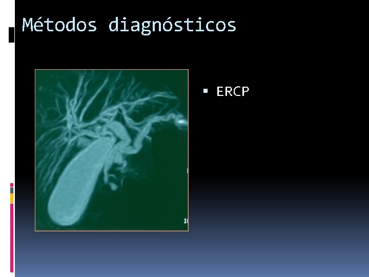 Métodos diagnósticos ERCP 