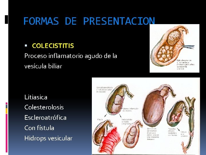 FORMAS DE PRESENTACION COLECISTITIS Proceso inflamatorio agudo de la vesícula biliar Litiasica Colesterolosis Escleroatrófica