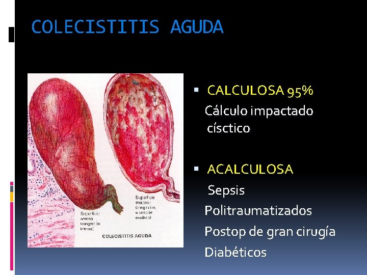 COLECISTITIS AGUDA CALCULOSA 95% Cálculo impactado císctico ACALCULOSA Sepsis Politraumatizados Postop de gran cirugía