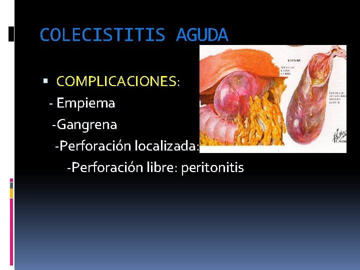 COLECISTITIS AGUDA COMPLICACIONES: - Empiema -Gangrena -Perforación localizada: -Perforación libre: peritonitis 