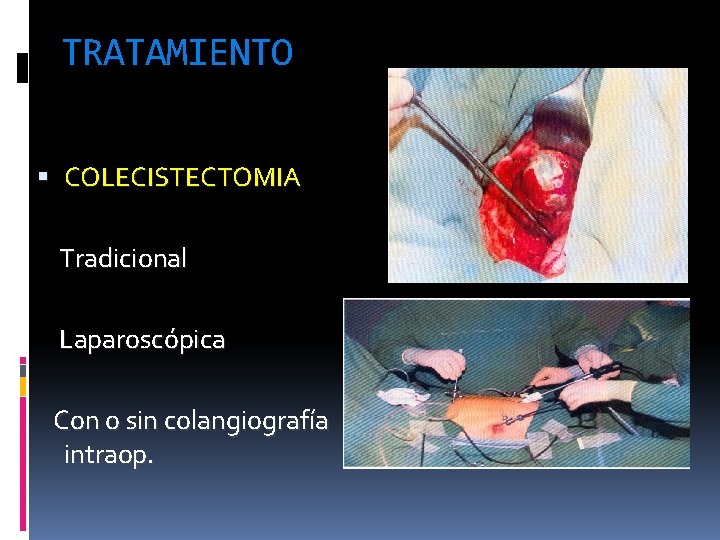 TRATAMIENTO COLECISTECTOMIA Tradicional Laparoscópica Con o sin colangiografía intraop. 