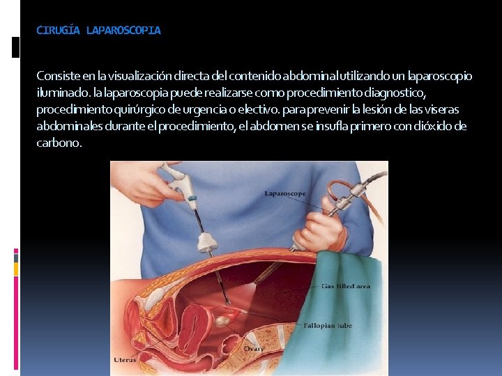 CIRUGÍA LAPAROSCOPIA Consiste en la visualización directa del contenido abdominal utilizando un laparoscopio iluminado.