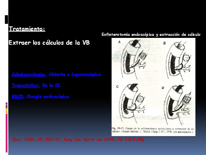 Tratamiento: Esfinterotomía endoscópica y extracción de cálculo Extraer los cálculos de la VB Coledocostomía: