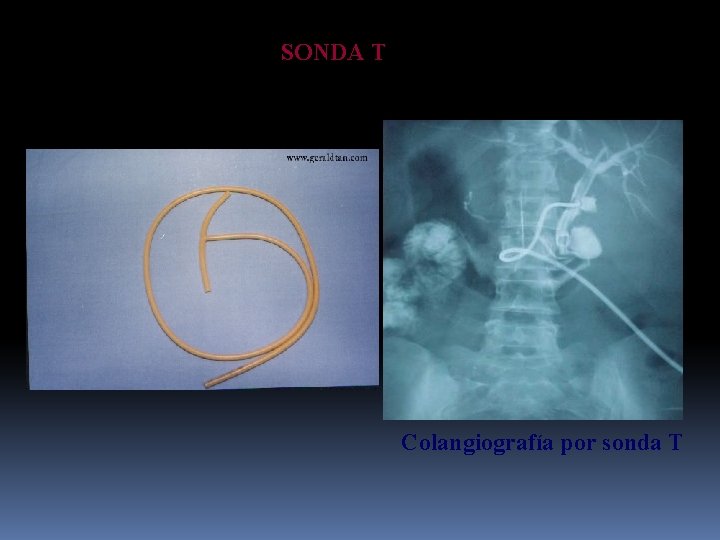 SONDA T Colangiografía por sonda T 