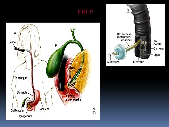 ERCP 