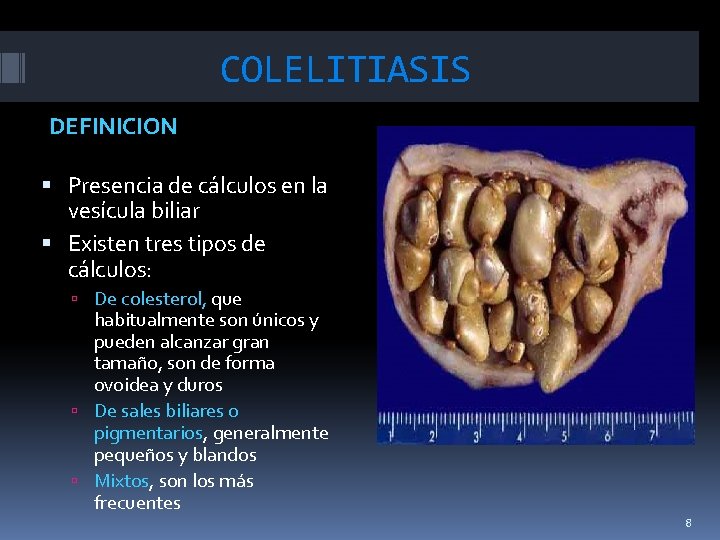 COLELITIASIS DEFINICION Presencia de cálculos en la vesícula biliar Existen tres tipos de cálculos: