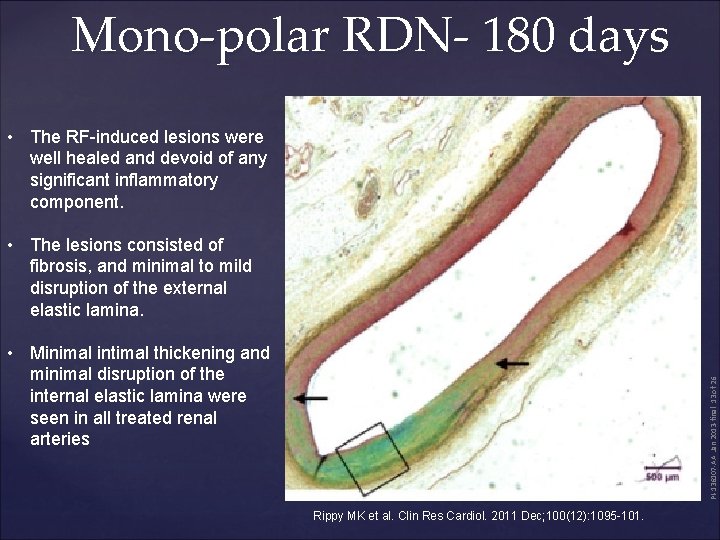 Mono-polar RDN- 180 days • The RF-induced lesions were well healed and devoid of