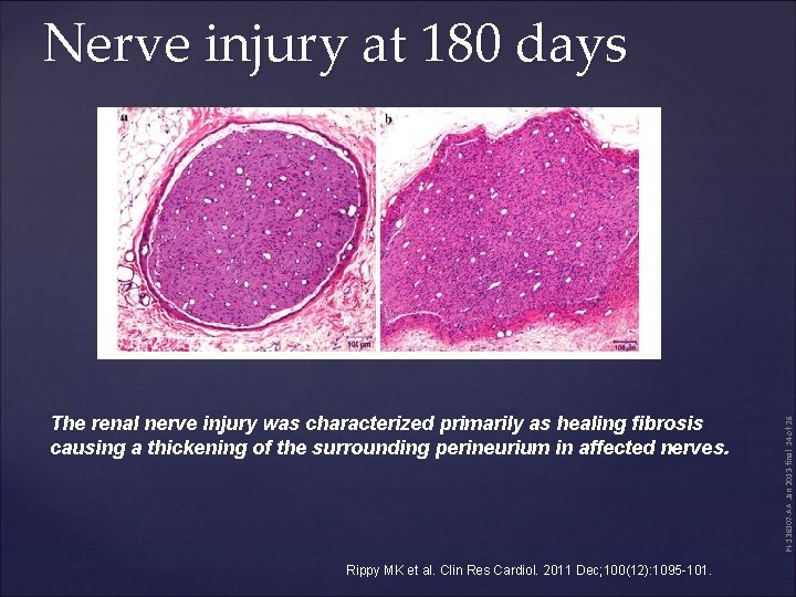 The renal nerve injury was characterized primarily as healing fibrosis causing a thickening of