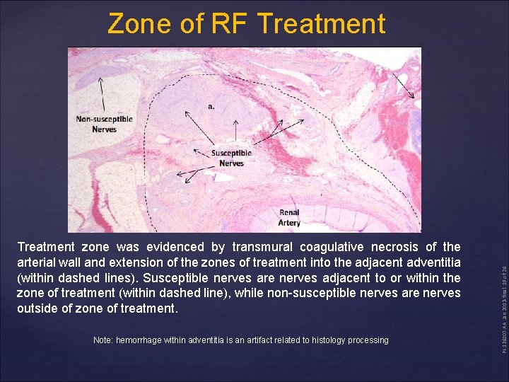 Treatment zone was evidenced by transmural coagulative necrosis of the arterial wall and extension