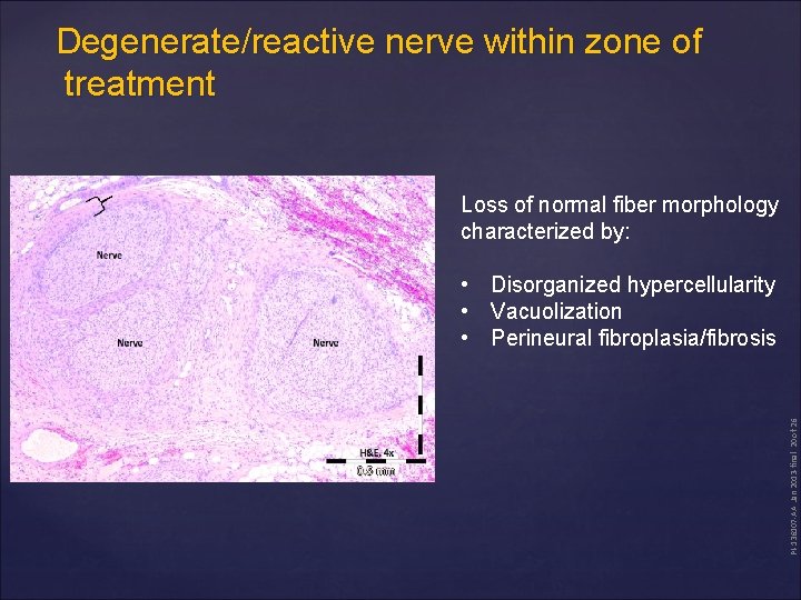 Degenerate/reactive nerve within zone of treatment Loss of normal fiber morphology characterized by: PI-136107