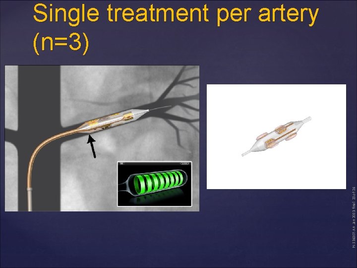 PI-136107 -AA Jan 2013 -final 21 of 26 Single treatment per artery (n=3) 