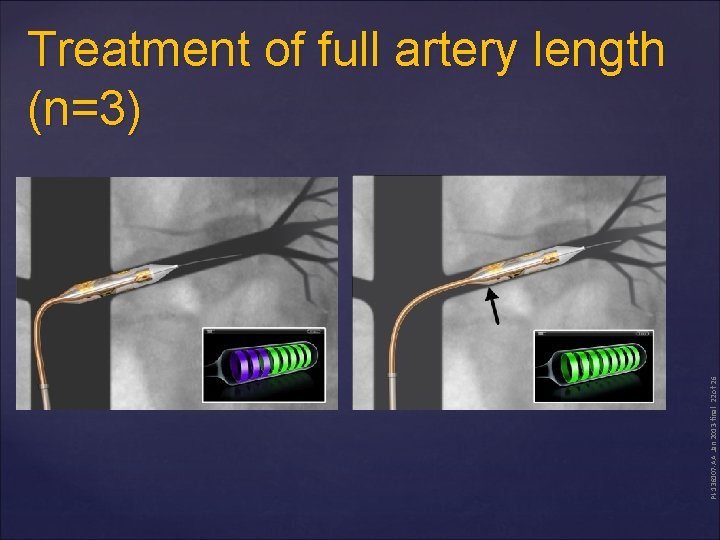 PI-136107 -AA Jan 2013 -final 22 of 26 Treatment of full artery length (n=3)