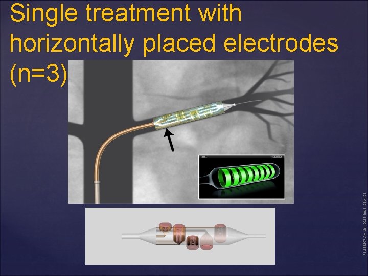 PI-136107 -AA Jan 2013 -final 23 of 26 Single treatment with horizontally placed electrodes