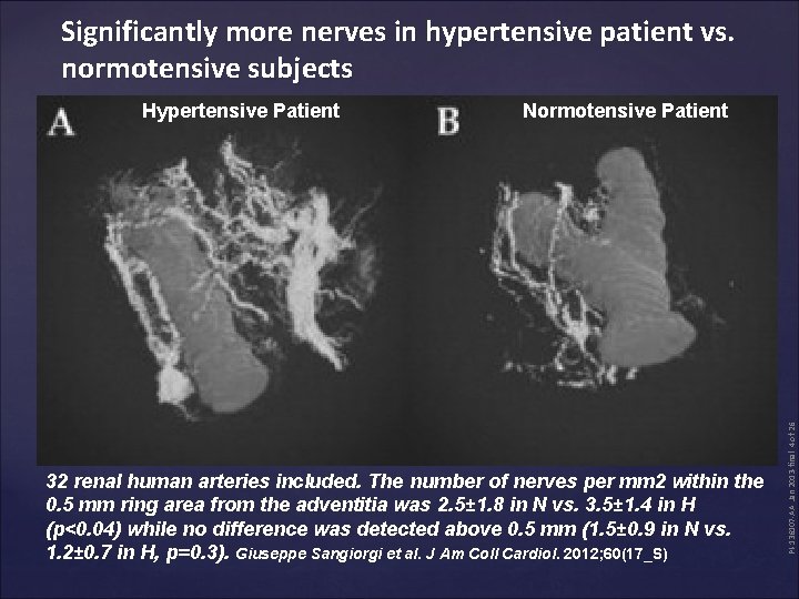 Significantly more nerves in hypertensive patient vs. normotensive subjects Normotensive Patient 32 renal human