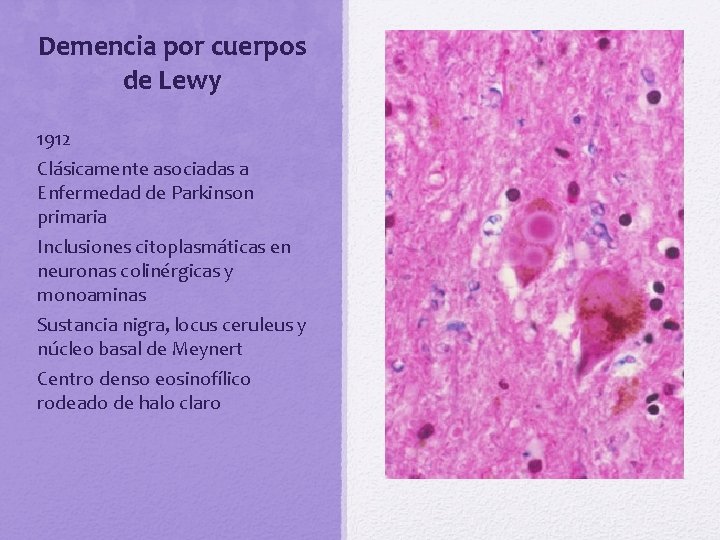 Demencia por cuerpos de Lewy 1912 Clásicamente asociadas a Enfermedad de Parkinson primaria Inclusiones