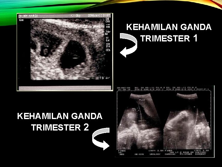 KEHAMILAN GANDA TRIMESTER 1 KEHAMILAN GANDA TRIMESTER 2 