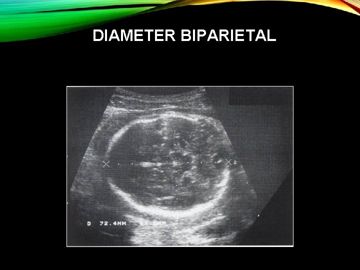 DIAMETER BIPARIETAL 