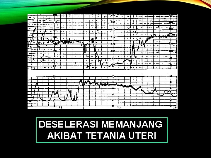 DESELERASI MEMANJANG AKIBAT TETANIA UTERI 